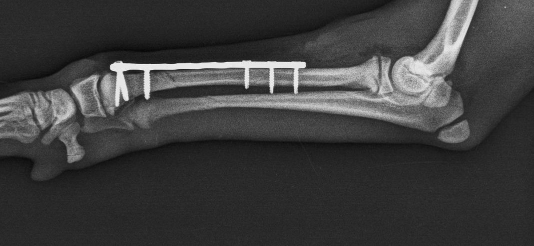 Fractura cúbito y radio post