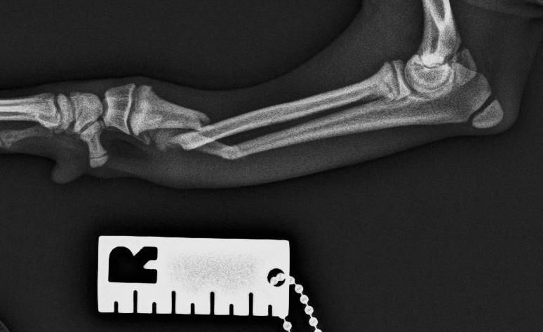 Fractura cúbito y radio